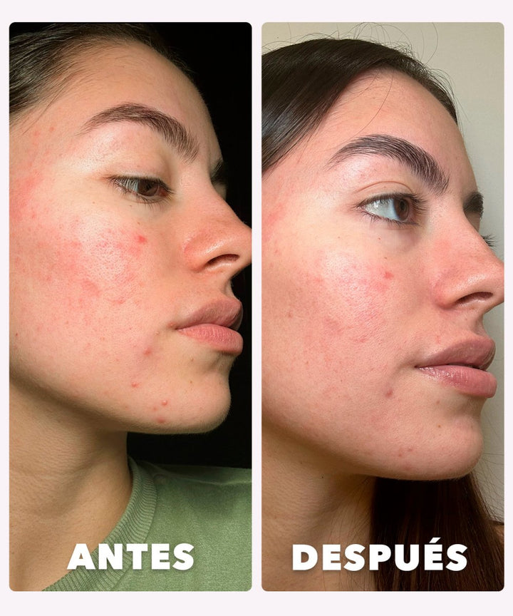 Antes y después de Laura, usando el limpiador facial.